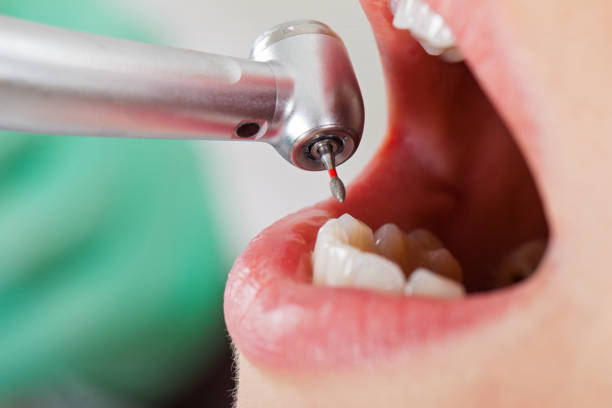 Best Emergency Dental Care for Abscessed Tooth in Oneonta, NY